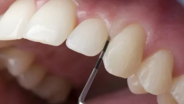 Bản chất của bọc răng sứ không cần mài thực chất là dán sứ Veneer
