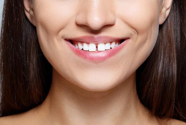 Răng thưa có thể cải thiện bằng phương pháp bọc sứ.