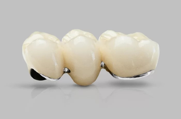 bọc răng sứ kim loại
