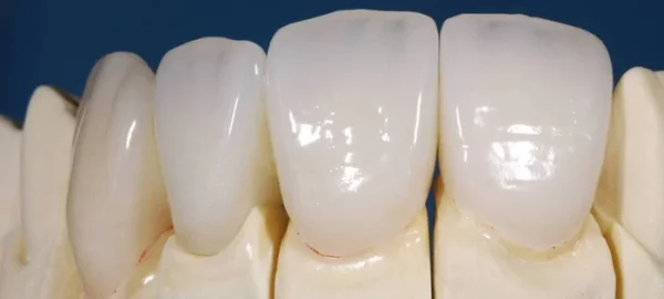 Răng toàn sứ có rất nhiều ưu điểm nhưng chi phí khá cao