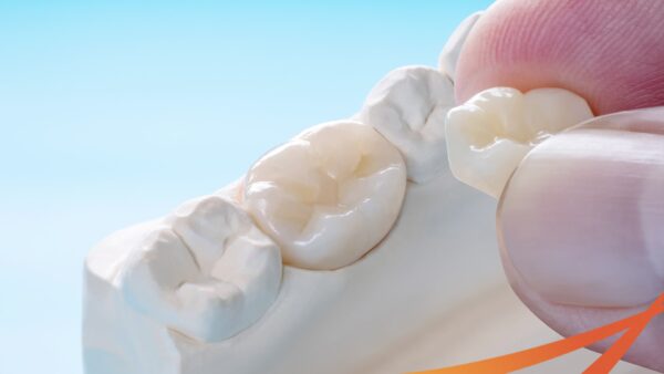 Tìm hiểu bọc răng sứ loại nào thì tốt, top 5 mão răng sứ cực đẹp-1