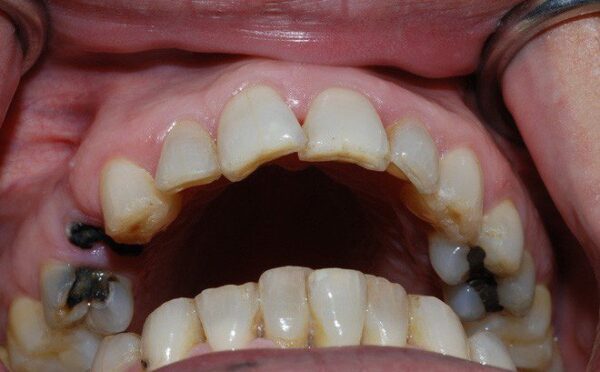 Tìm hiểu về các khái niệm liên quan bọc răng sứ cho răng sâu