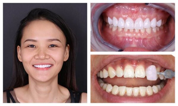 Các biện pháp kéo dài tuổi thọ răng bọc sứ