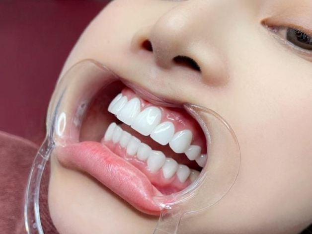 bọc răng sứ 2 răng cửa giá bao nhiêu