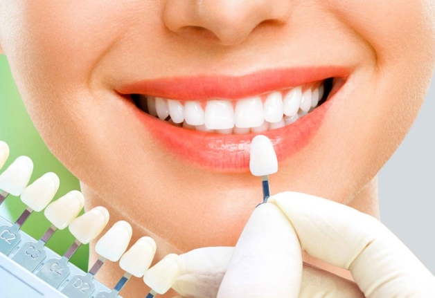 bọc răng sứ 2 răng cửa giá bao nhiêu