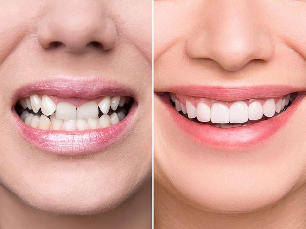bọc răng sứ 4 răng cửa giá bao nhiêu thì tốt