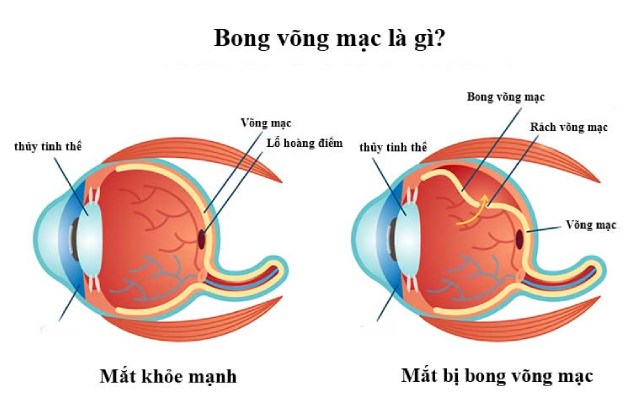 bong võng mạc
