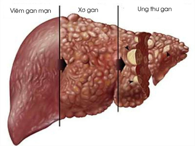 các mũi tiêm phòng viêm gan b