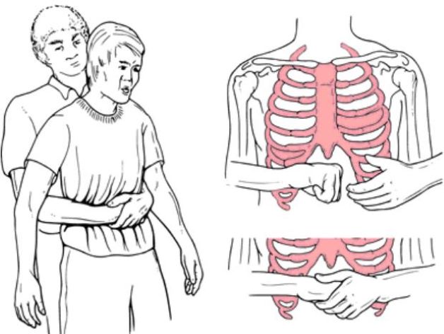 cách chữa hóc xương ếch bằng nghiệm pháp Heimlich nếu cần