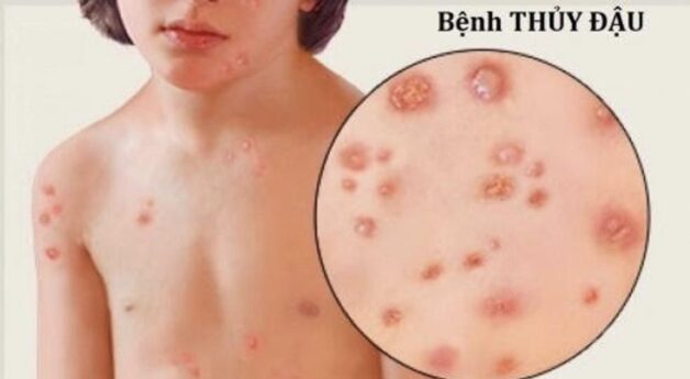 Bệnh thủy đậu đã có từ lâu và rất dễ lây nhiễm