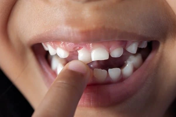 cách làm cho răng sâu tự rụng
