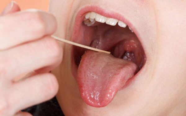 Nhờ người xung quanh trợ giúp gắp bỏ mảnh xương bị hóc
