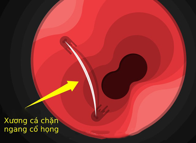 Minh họa cách lấy xương mắc cổ