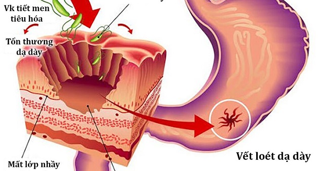 cách trị dạ dày hp gây viêm loét