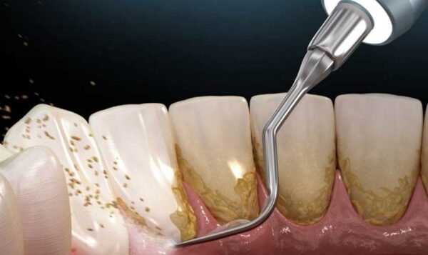 Cao răng có mấy loại phổ biến
