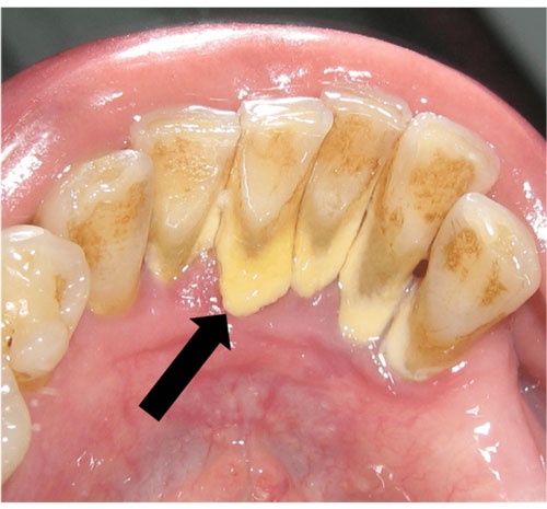 Tại sao cần phải xử lý ngay cao răng độ 2?