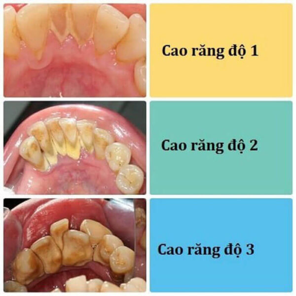 Tổng quan về cao răng