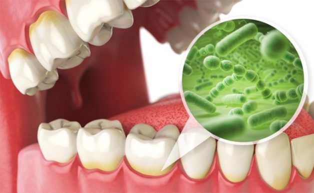 Mảng bám cao răng gây nhiều ảnh hưởng không tốt tới sức khỏe răng miệng