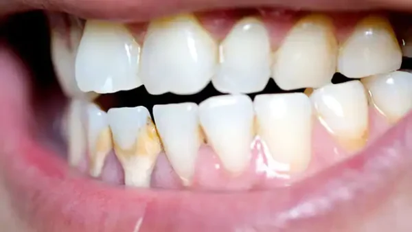 cao răng và mảng bám
