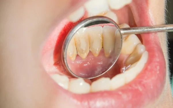 Mảng bám răng hình thành ngay từ khi bạn đánh răng xong