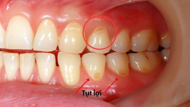 Cao răng để lâu có thể gây ra tụt lợi