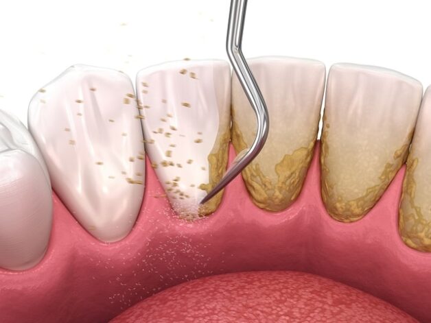 cạo vôi răng giá rẻ có thể không đảm bảo an toàn và hiệu quả
