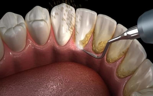 cạo vôi răng tẩy trắng răng