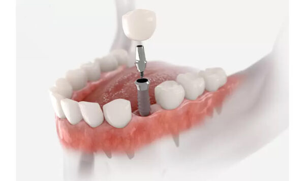 cấy ghép implant giá rẻ nhất