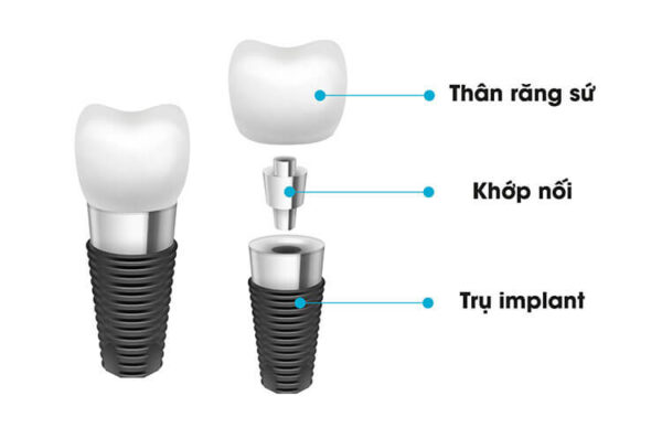 Cấy ghép răng Implant bao nhiêu tiền hiện nay?