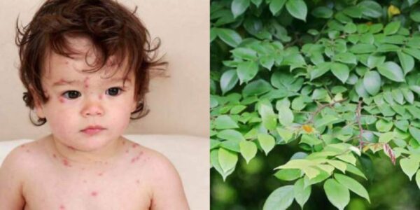 cây thuốc nam chữa bệnh thủy đậu
