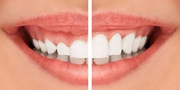 Tiêm chất giãn cơ có thể phù hợp với trường hợp nhẹ