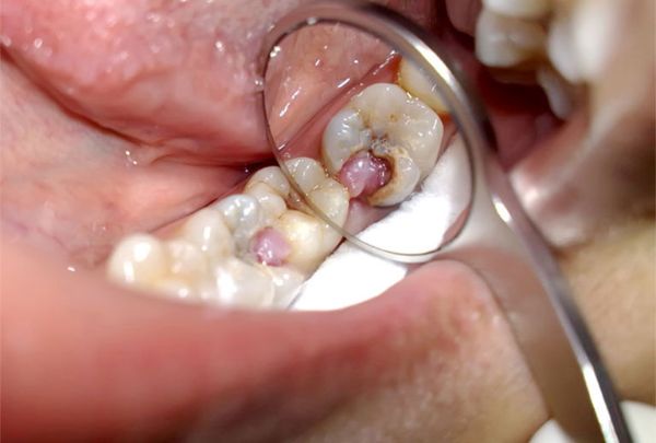 chi phí điều trị răng sâu lồi thịt