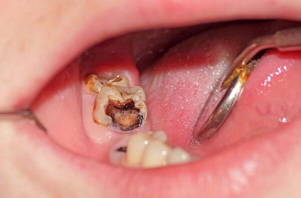điều trị răng sâu lồi thịt