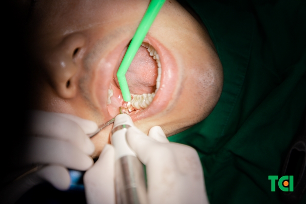 trị răng sâu lồi thịt