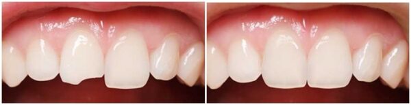 Những yếu tố nào ảnh hưởng đến chi phí hàn răng mẻ?