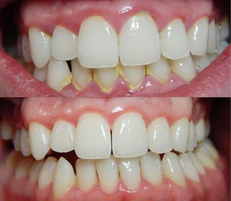Cao răng xuất hiện khi thức ăn, mảng bám không được loại bỏ thường xuyên