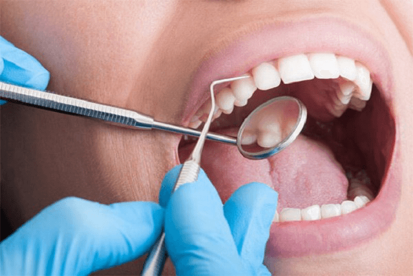 Nên duy trì thói quen lấy cao răng khoảng 6 tháng/lần