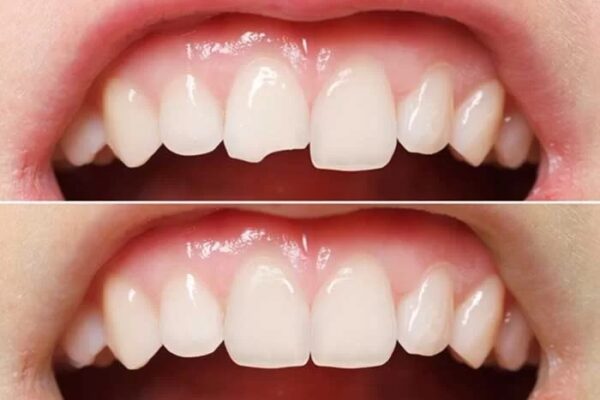 chi phí trám răng bị mẻ