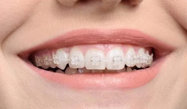niềng răng tốt và tối ưu chi phí-3