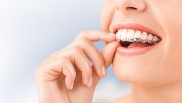 Các phương pháp niềng răng tốt