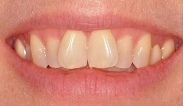 Một số thói quen xấu từ nhỏ cũng có thể làm răng cửa bị lệch
