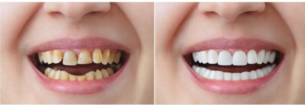 Răng sứ không chỉ cải thiện một số vấn đề răng miệng mà còn giúp nụ cười đẹp hơn