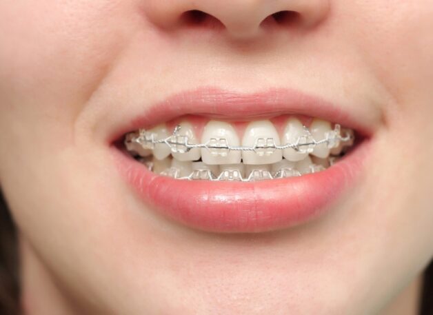 Niềng răng là một cách chữa cười hở lợi không phẫu thuật.