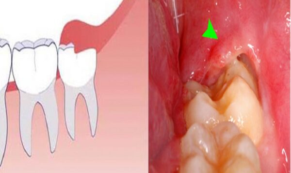 có cần thiết phải nhổ răng khôn