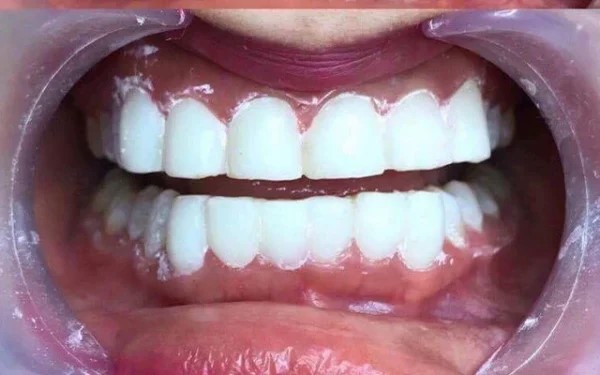 Phương pháp dán phủ sứ răng có thể thích hợp trong một số trường hợp