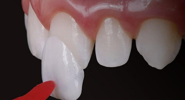 dán răng sứ Veneer ở đâu tốt