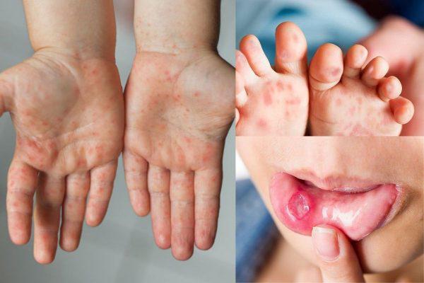 Các yếu tố gây bệnh và đường lây nhiễm bệnh tay chân miệng ở trẻ em