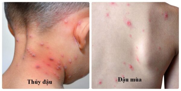 Đậu mùa và thủy đậu là 2 bệnh khác nhau chớ nhầm lẫn-1