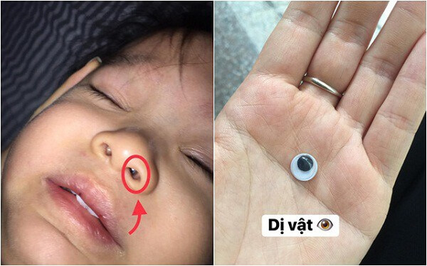 Xem ngay cách xử trí dị vật trong mũi bé