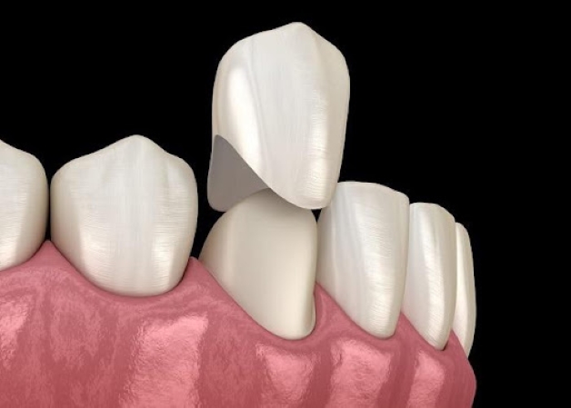 chỉnh răng mọc lệch bằng phương pháp bọc sứ